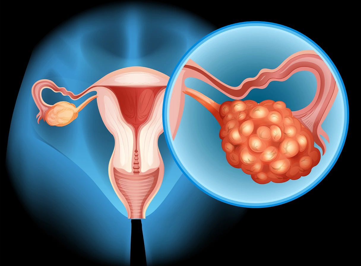 Tips for Managing Polycystic Ovary Syndrome (PCOS) Effectively
